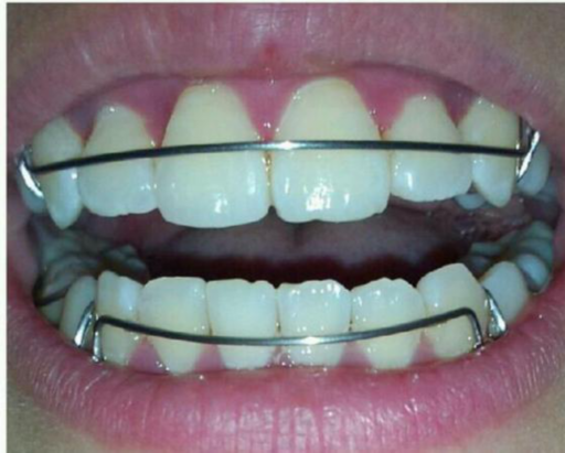 隐形牙套的弊端（国产隐形牙套排名）(图1)